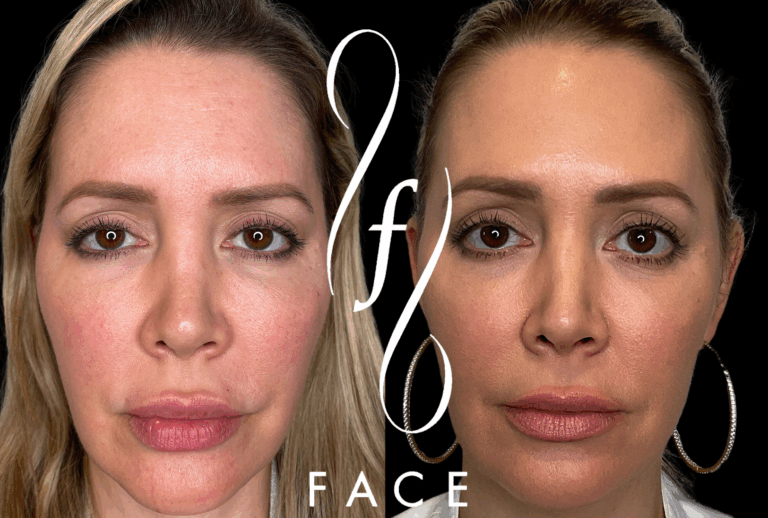 HOLLY EMFACE (2)