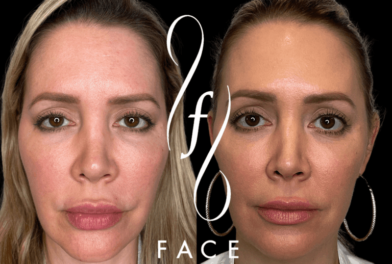 HOLLY EMFACE (2)