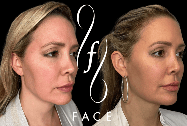 HOLLY EMFACE