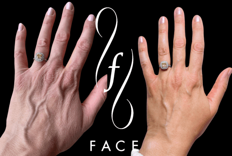 Holly VI Hand Peel (2)