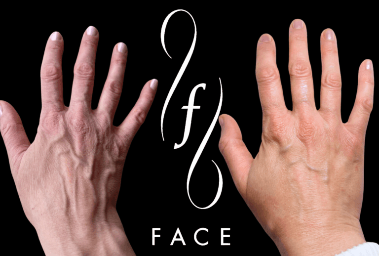 Holly VI Hand Peel