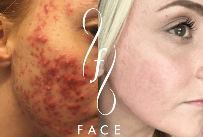 KATIE ACNE BA