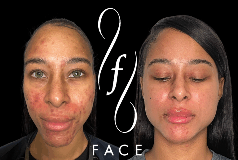 Lip Filler + Skincare