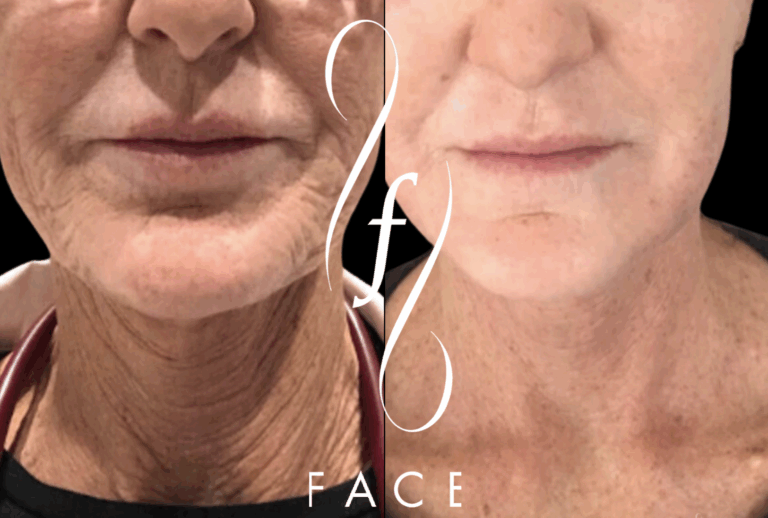 Neck Wrinkles