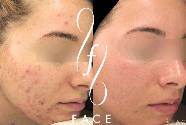 Patrina B. acne