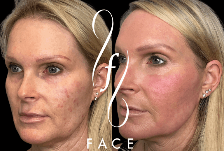 Pearl- antiaging,pigment, scarring (2)