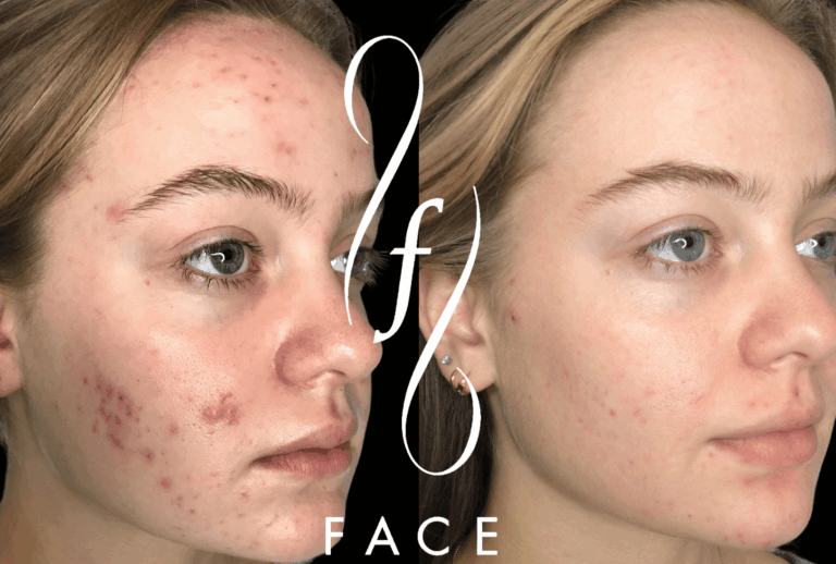 acne + scarring pearl laser