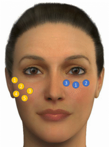 Jawline Contouring With Neurotoxins and Dermal Fillers