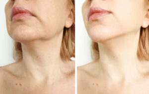  Skin Tightening Using Non-Ablative Laser