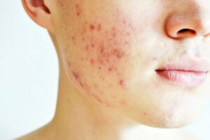 modern laser approaches to acne scars go away